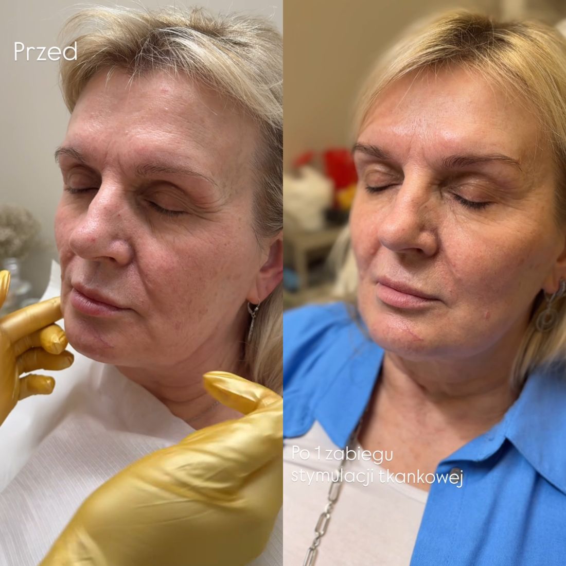 Stymulatory i odmładzanie skóry